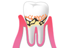 軽度歯周炎
