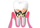 中等度歯周炎